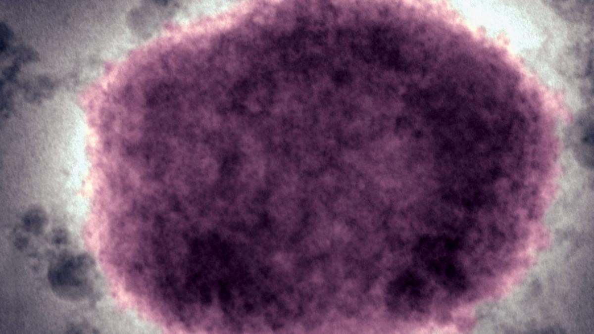 US CDC Reverts to Monkeypox Name for Disease After 2022 Change