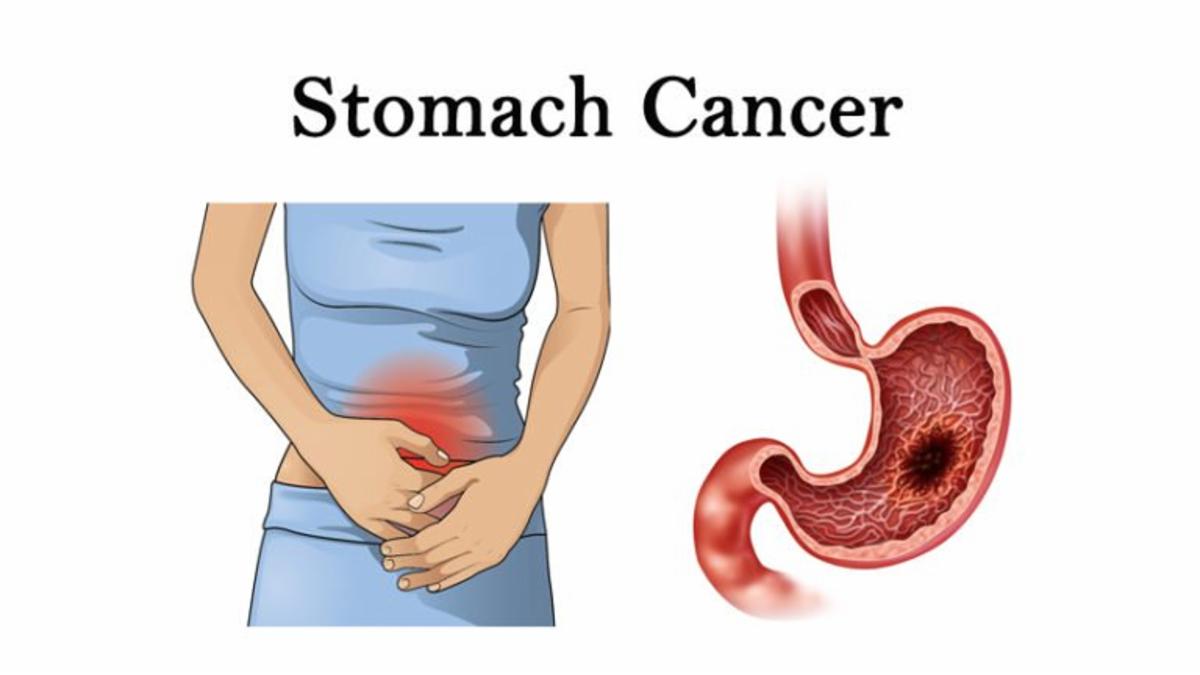 Why Japan, Mongolia, and Iran Lead the World in Stomach Cancer Rates