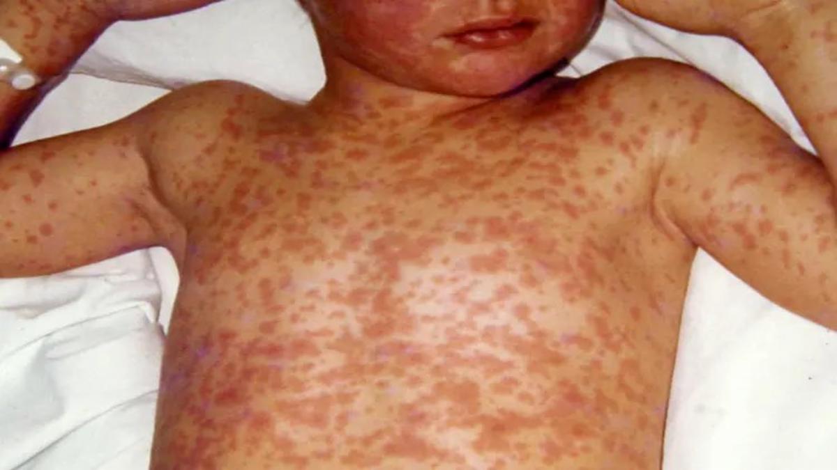 Measles Cases Rise in US 2025: Symptoms, Risks & Prevention